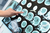 Thuốc điều trị cho người bệnh Alzheimer có kết quả khả quan