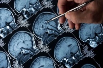 AI giúp phân loại khối u não chỉ trong vài giờ