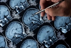 AI giúp phân loại khối u não chỉ trong vài giờ
