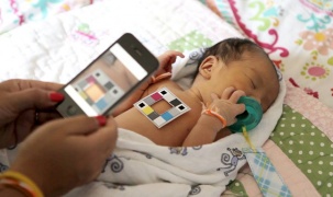 Ứng dụng điện thoại thông minh giúp chẩn đoán bệnh vàng da ở trẻ sơ sinh