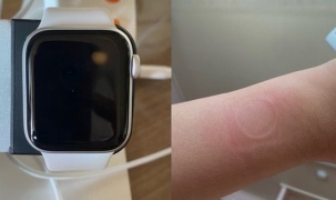 Đồng hồ “giá rẻ” Apple Watch SE khiến người dùng bị bỏng do quá tải nhiệt