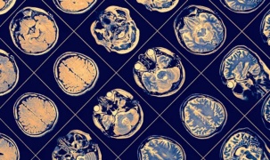 Trí tuệ nhân tạo IBM có thể dự đoán các triệu chứng của bệnh nhân Parkinson
