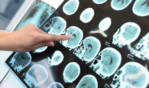 Thuốc điều trị cho người bệnh Alzheimer có kết quả khả quan